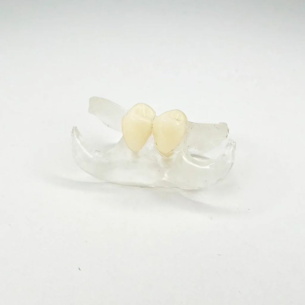 Clear Unilateral Partial Denture