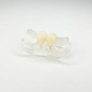 Clear Unilateral Partial Denture