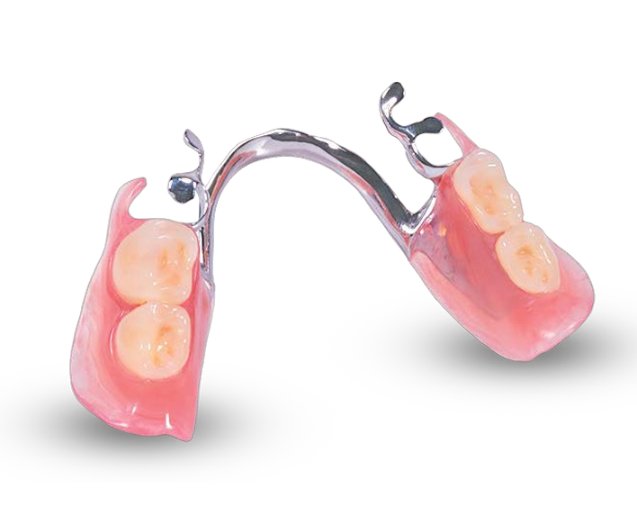Metal Partial Denture