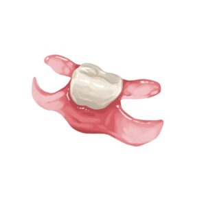 Unilateral Partial Denture