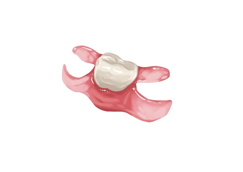 Unilateral Partial Denture